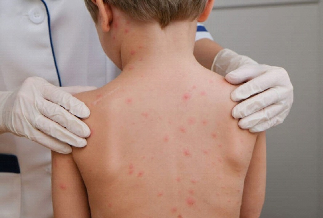 Vacinação contra meningite é ampliada em Ouro Preto. Criança com a doença.